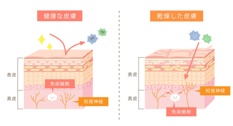 アトピー性皮膚炎の原因